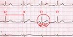 кардиограмма с RR интервалами